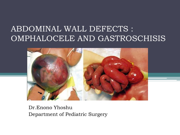 abdominal wall defects omphalocele