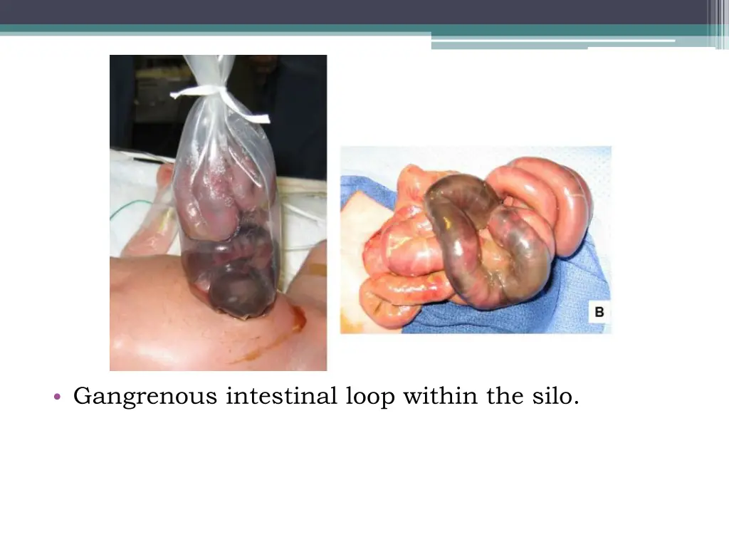 gangrenous intestinal loop within the silo