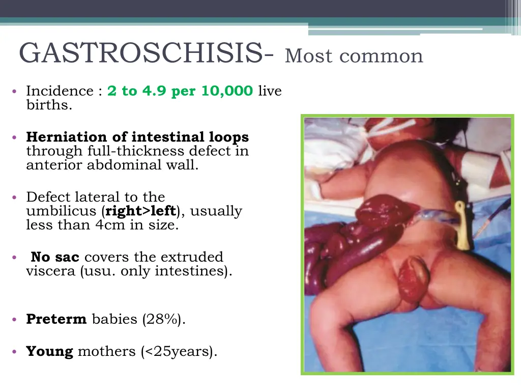 gastroschisis most common