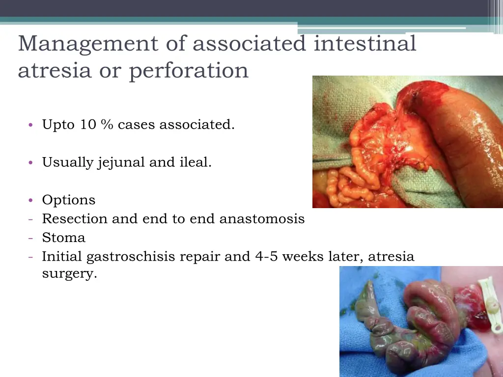 management of associated intestinal atresia