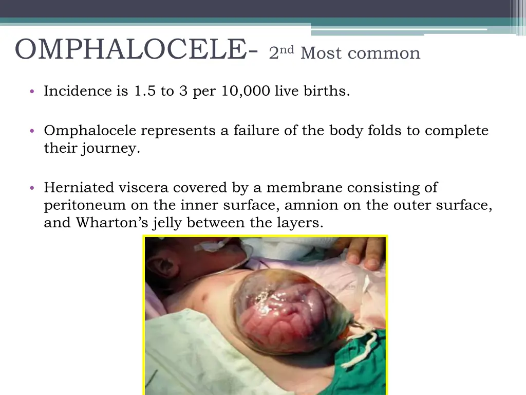 omphalocele 2 nd most common