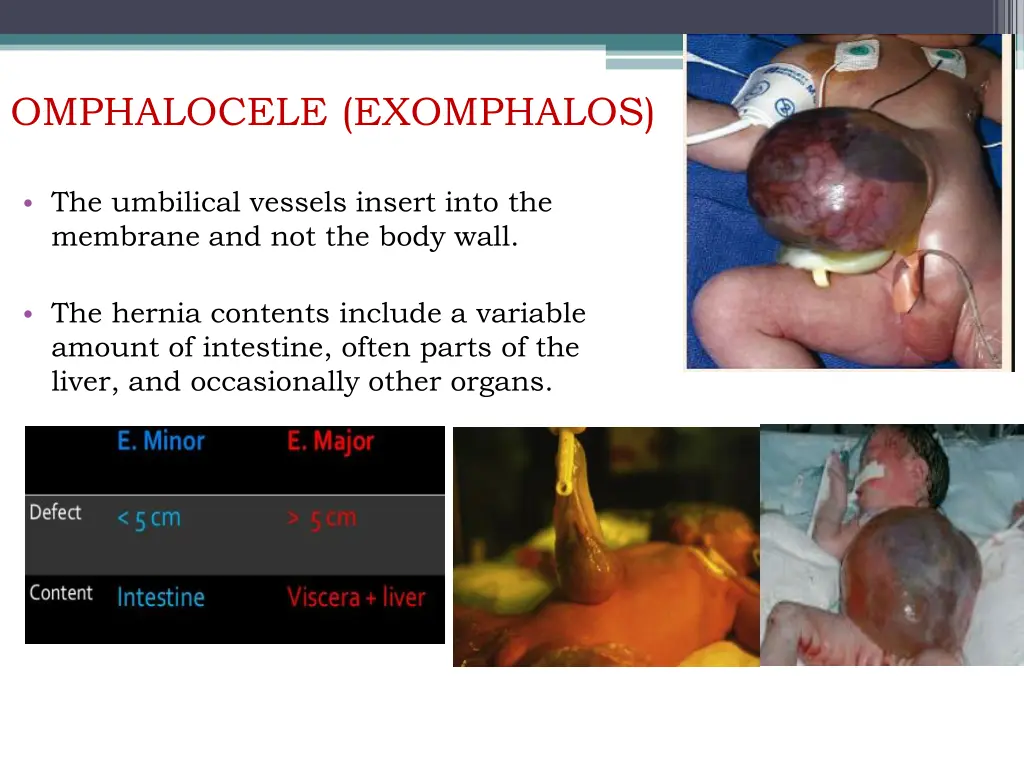 omphalocele exomphalos