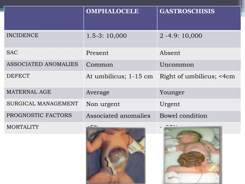 omphalocele