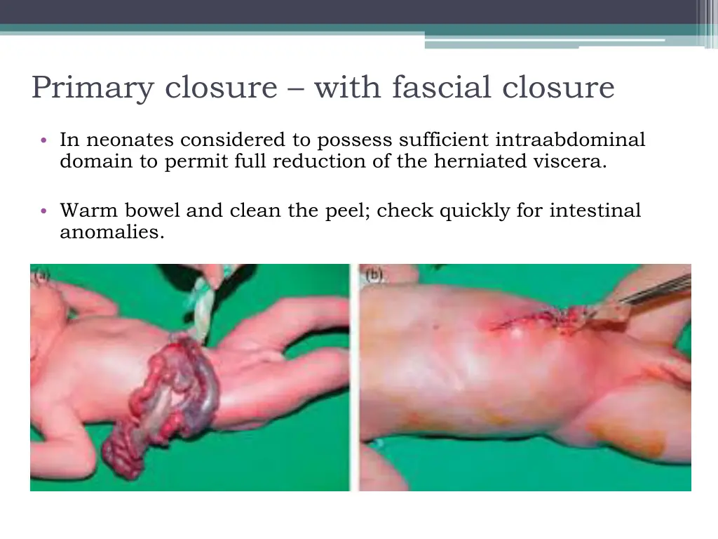 primary closure with fascial closure