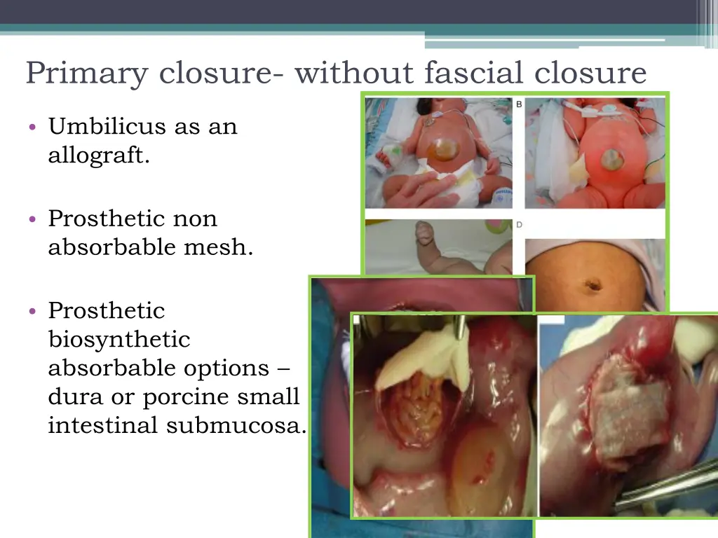 primary closure without fascial closure