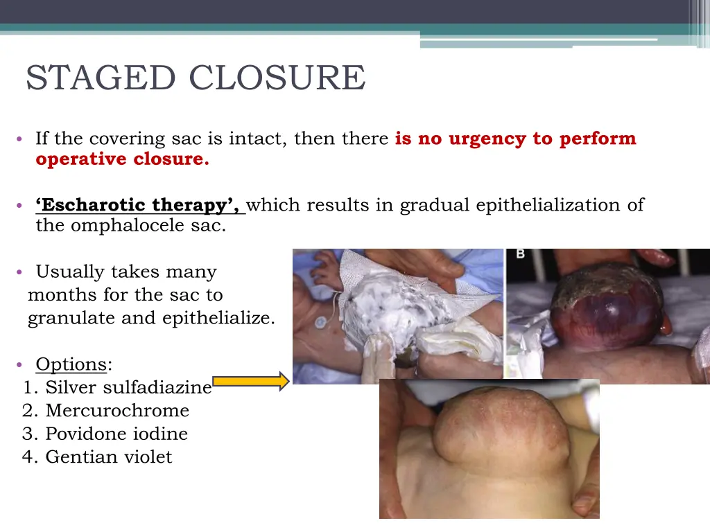 staged closure 1