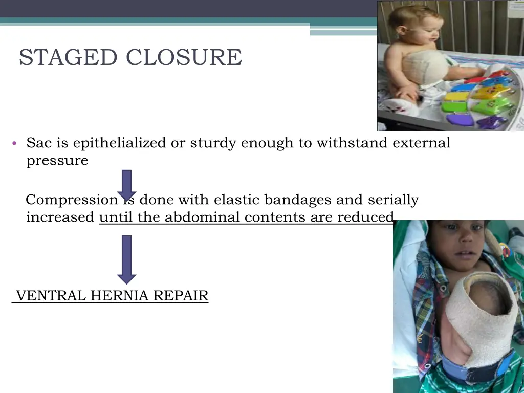 staged closure 2