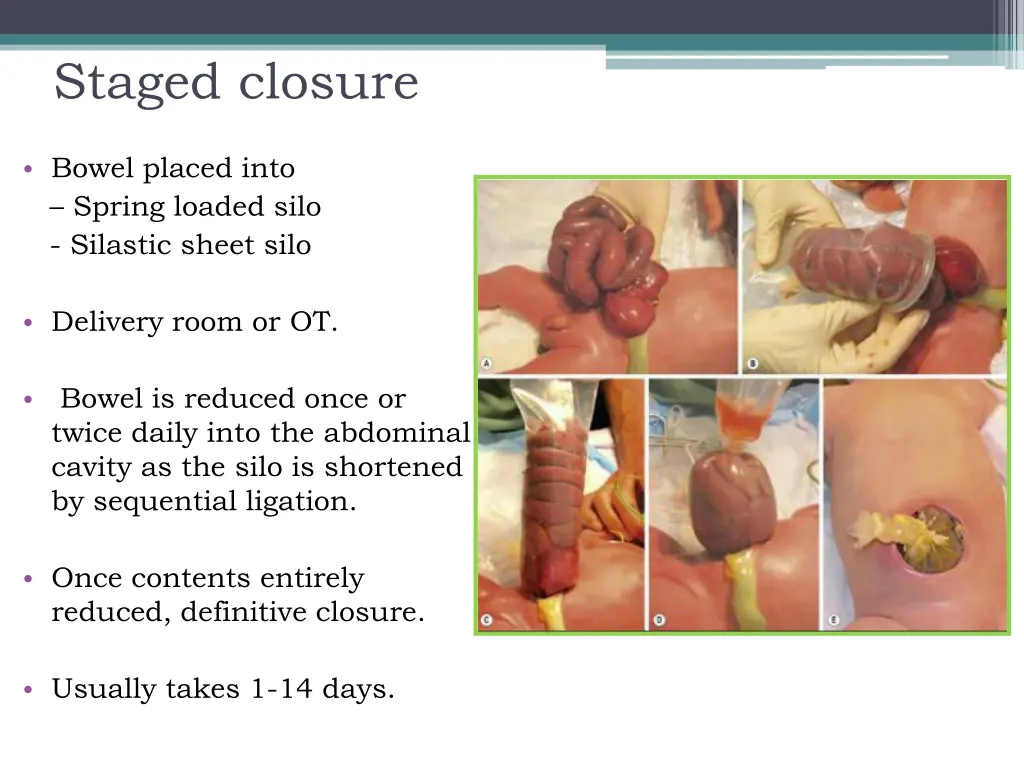 staged closure