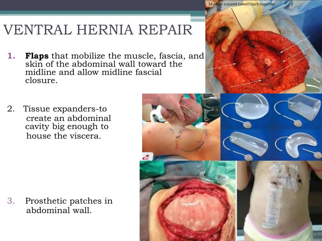 ventral hernia repair