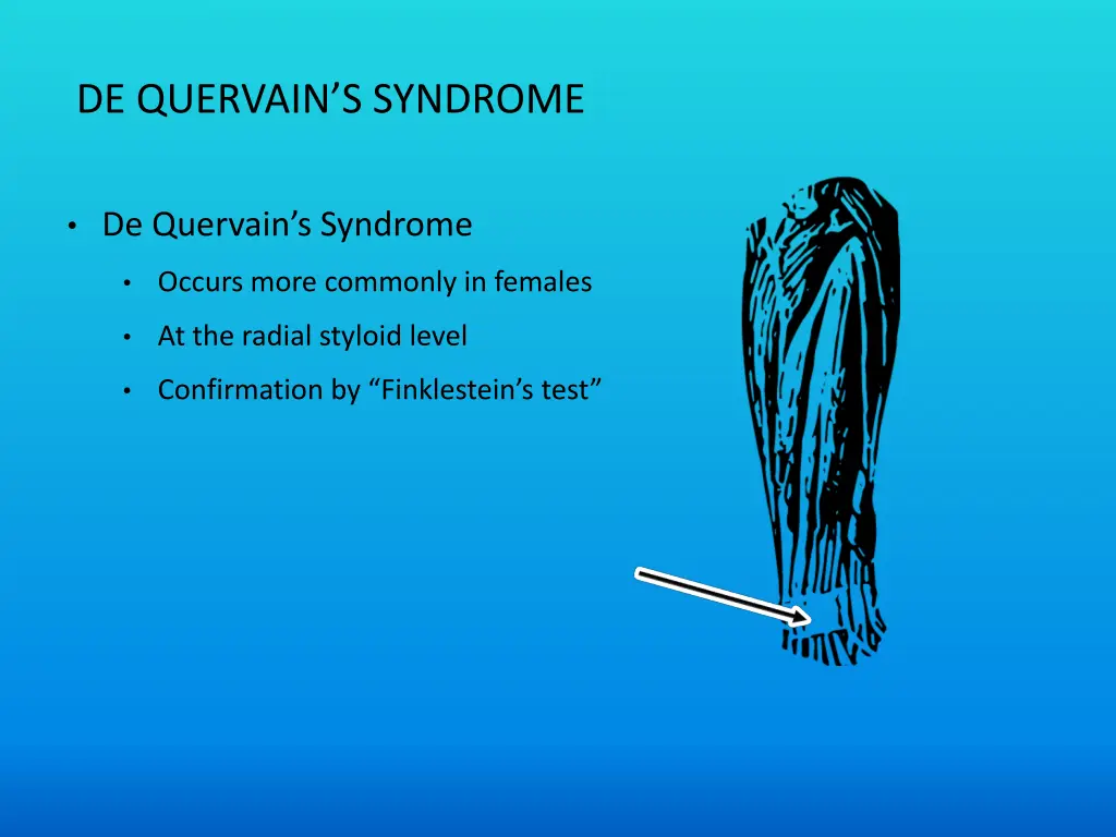 de quervain s syndrome