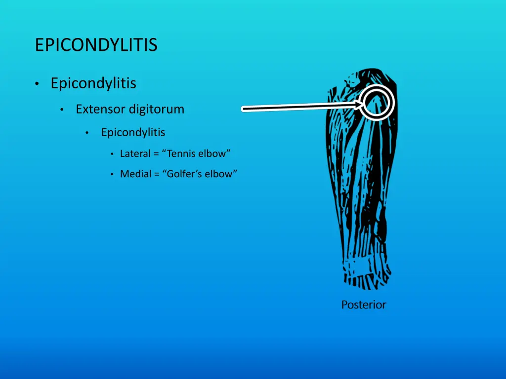 epicondylitis