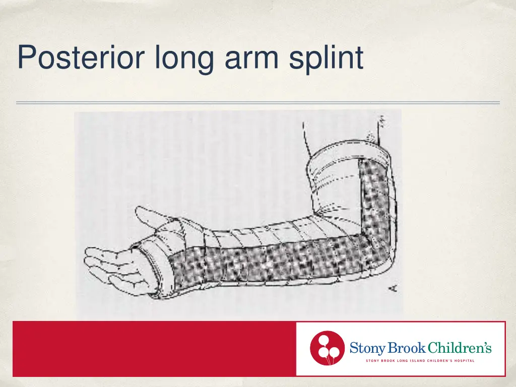 posterior long arm splint