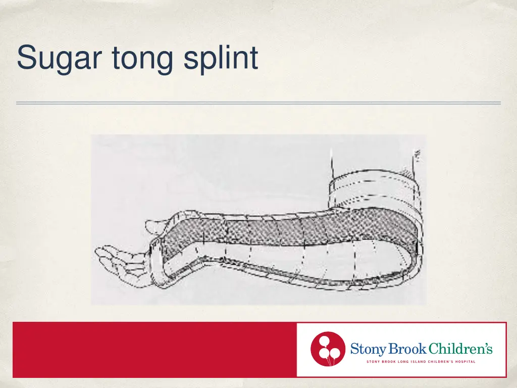 sugar tong splint