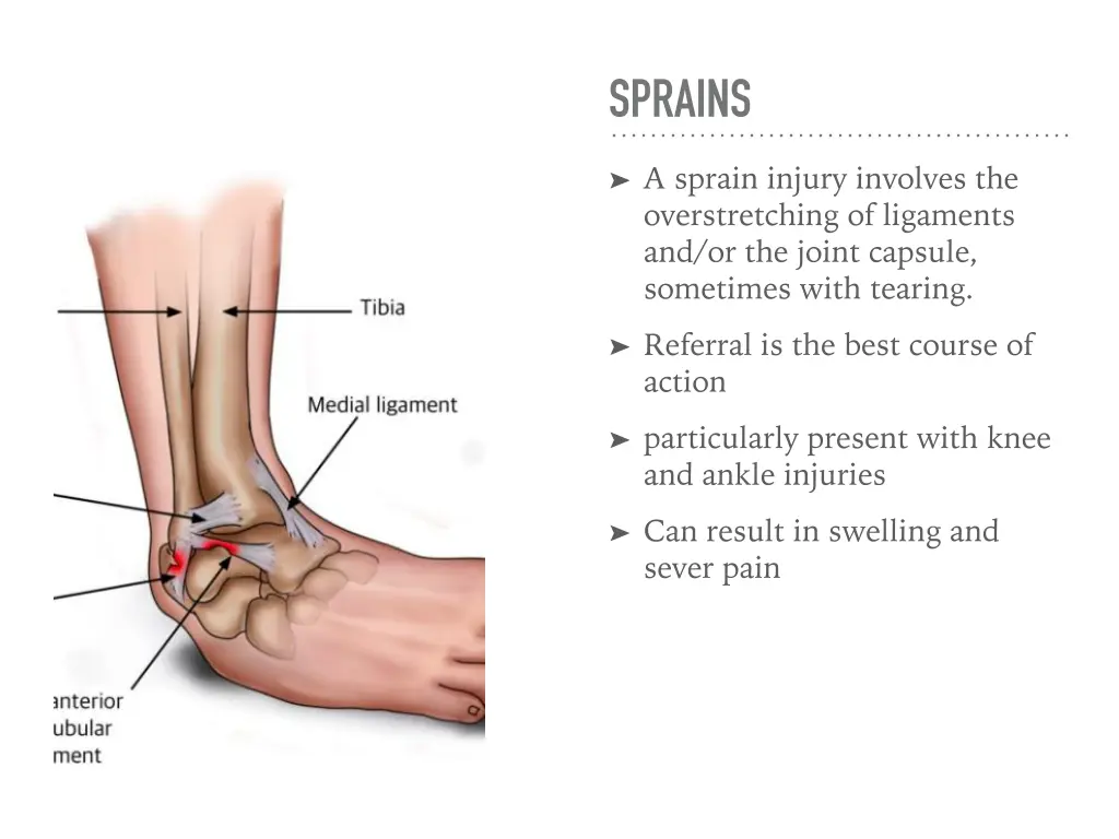 sprains