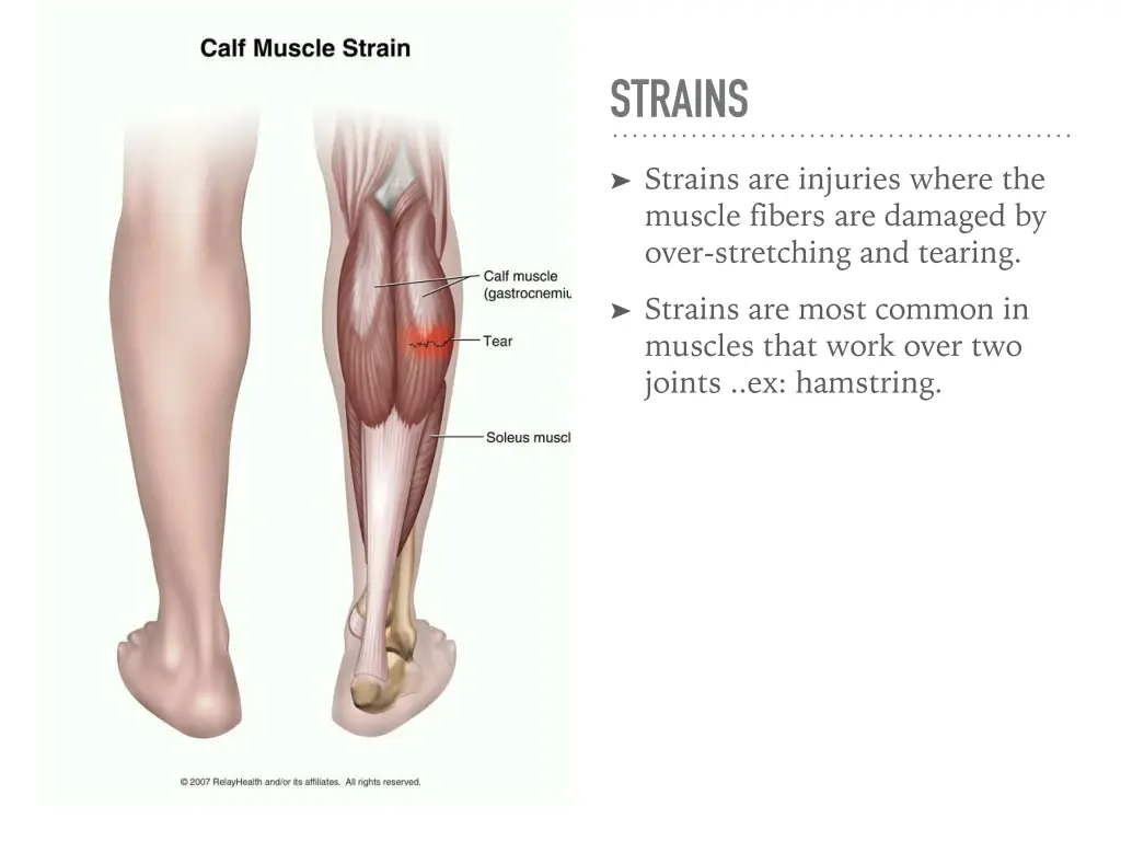 strains