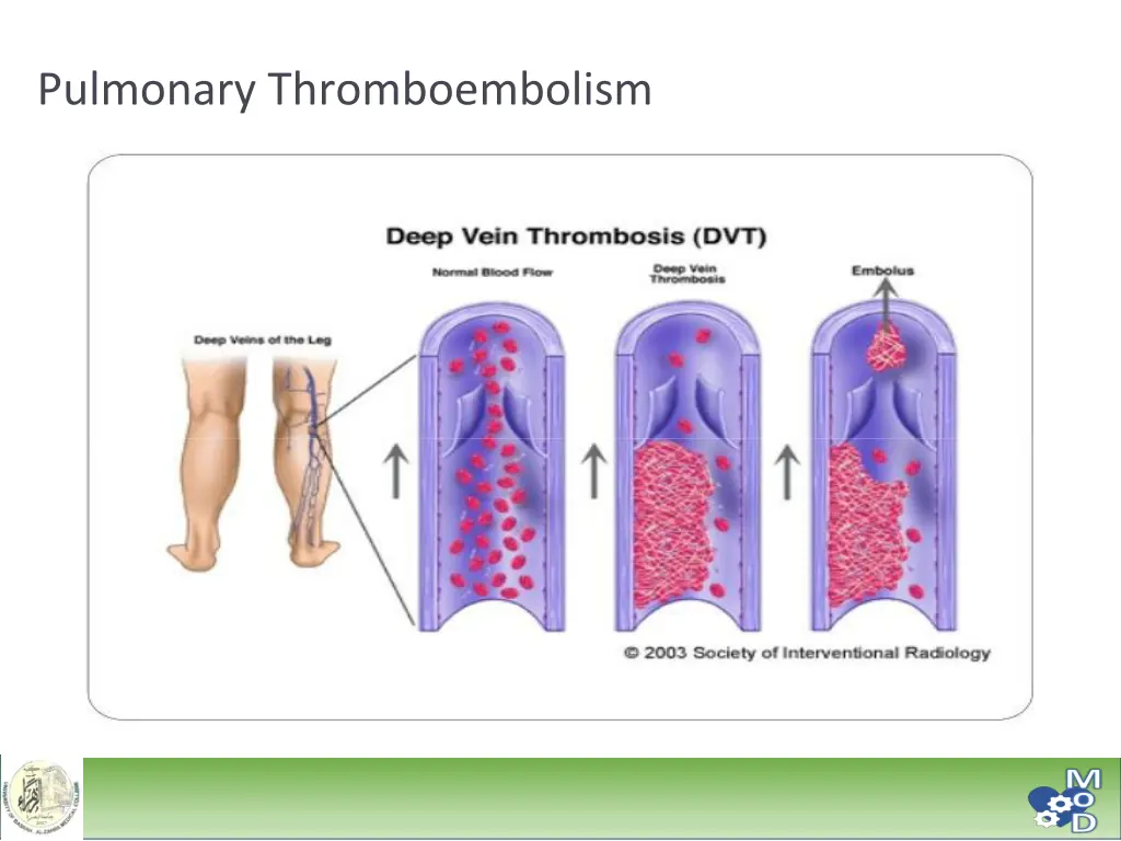 pulmonary thromboembolism 1