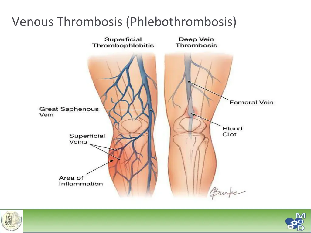 venous thrombosis phlebothrombosis 3