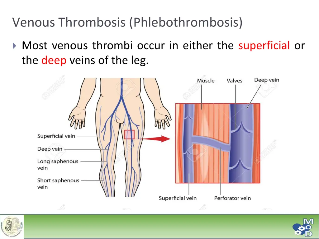 venous thrombosis phlebothrombosis