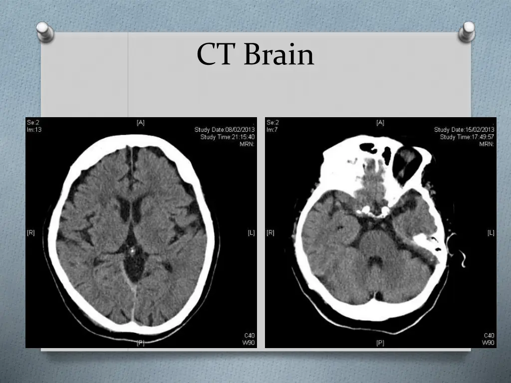 ct brain 1