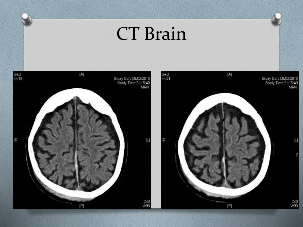 ct brain