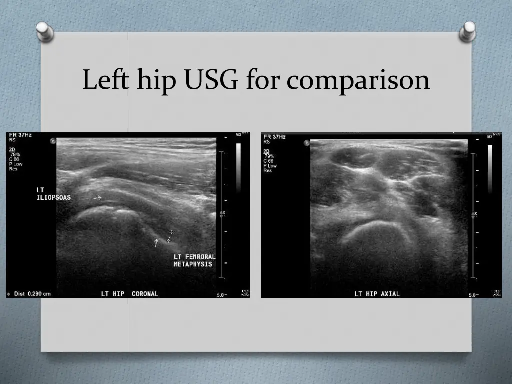 left hip usg for comparison