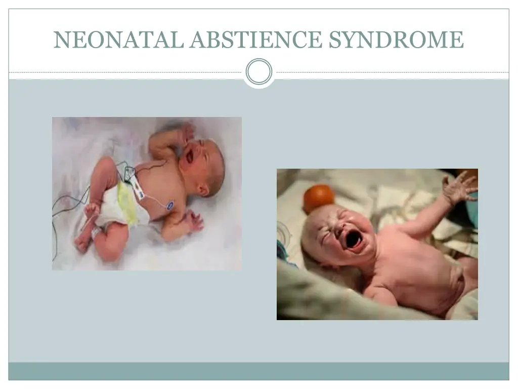 neonatal abstience syndrome