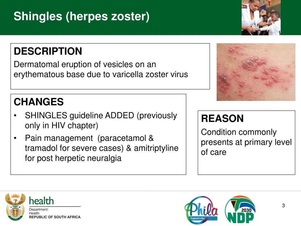 shingles herpes zoster