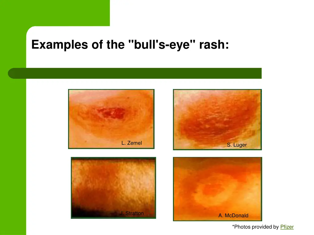 examples of the bull s eye rash