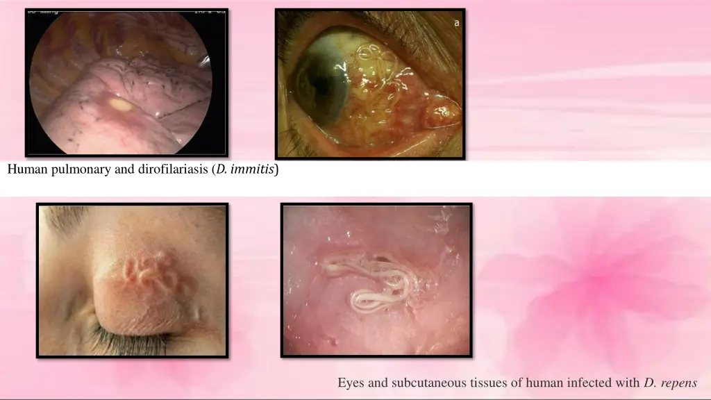 human pulmonary and dirofilariasis d immitis