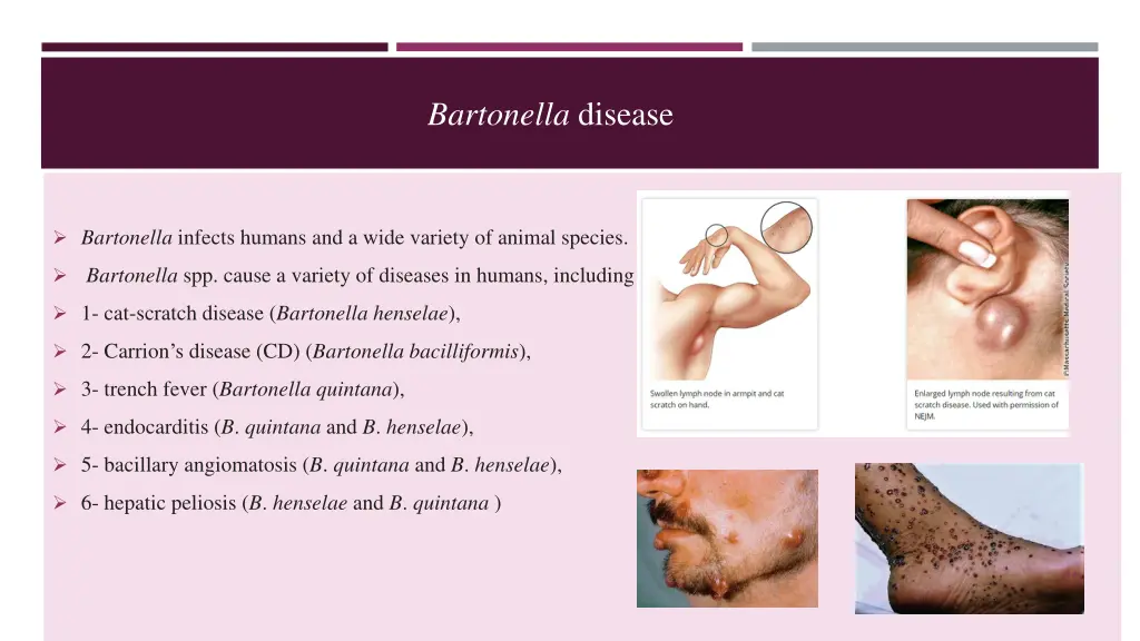 bartonella disease