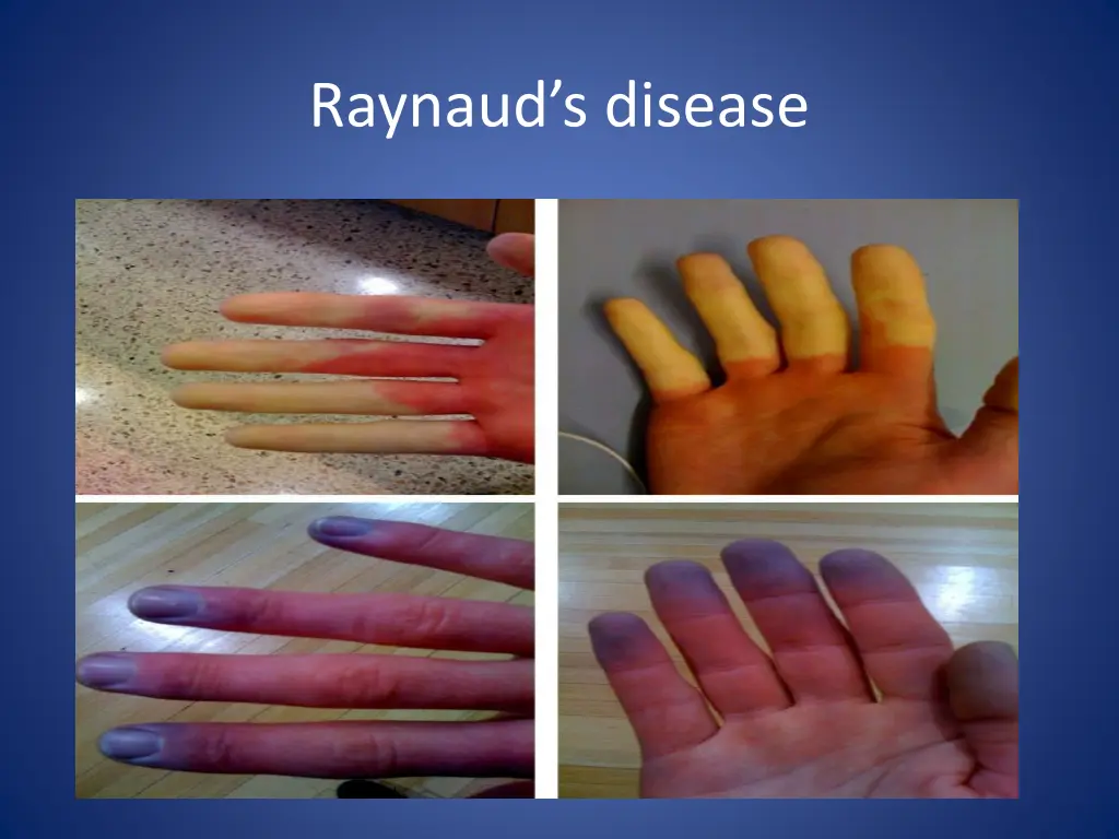 raynaud s disease