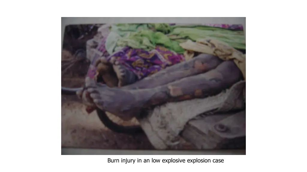 burn injury in an low explosive explosion case