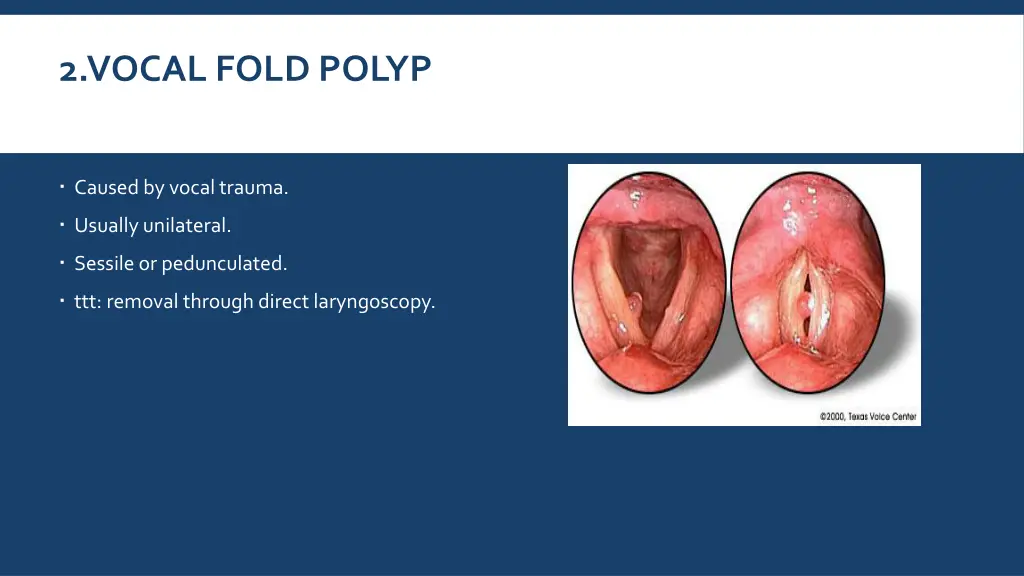 2 vocal fold polyp