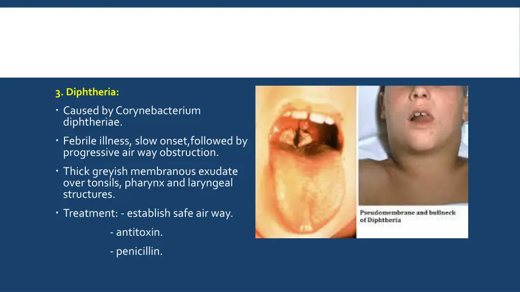 3 diphtheria caused by corynebacterium