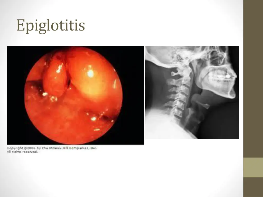 epiglotitis