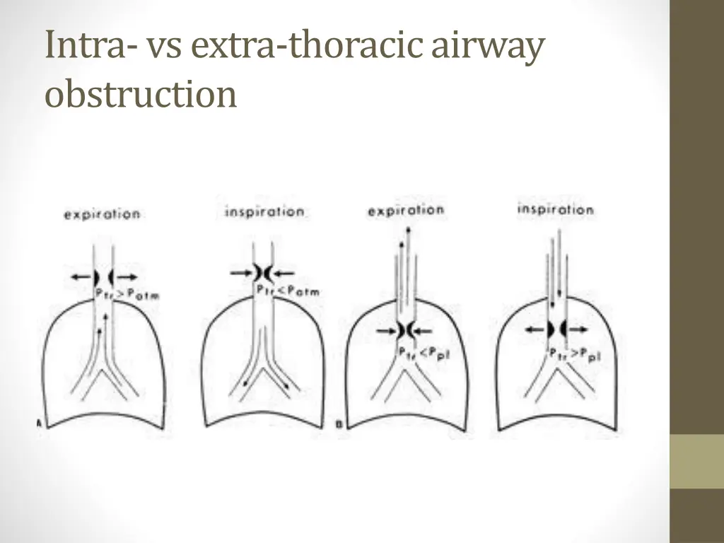 intra vs extra thoracic airway obstruction