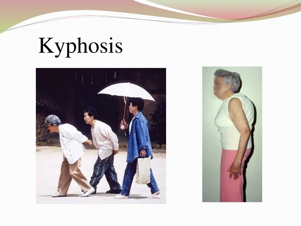 kyphosis