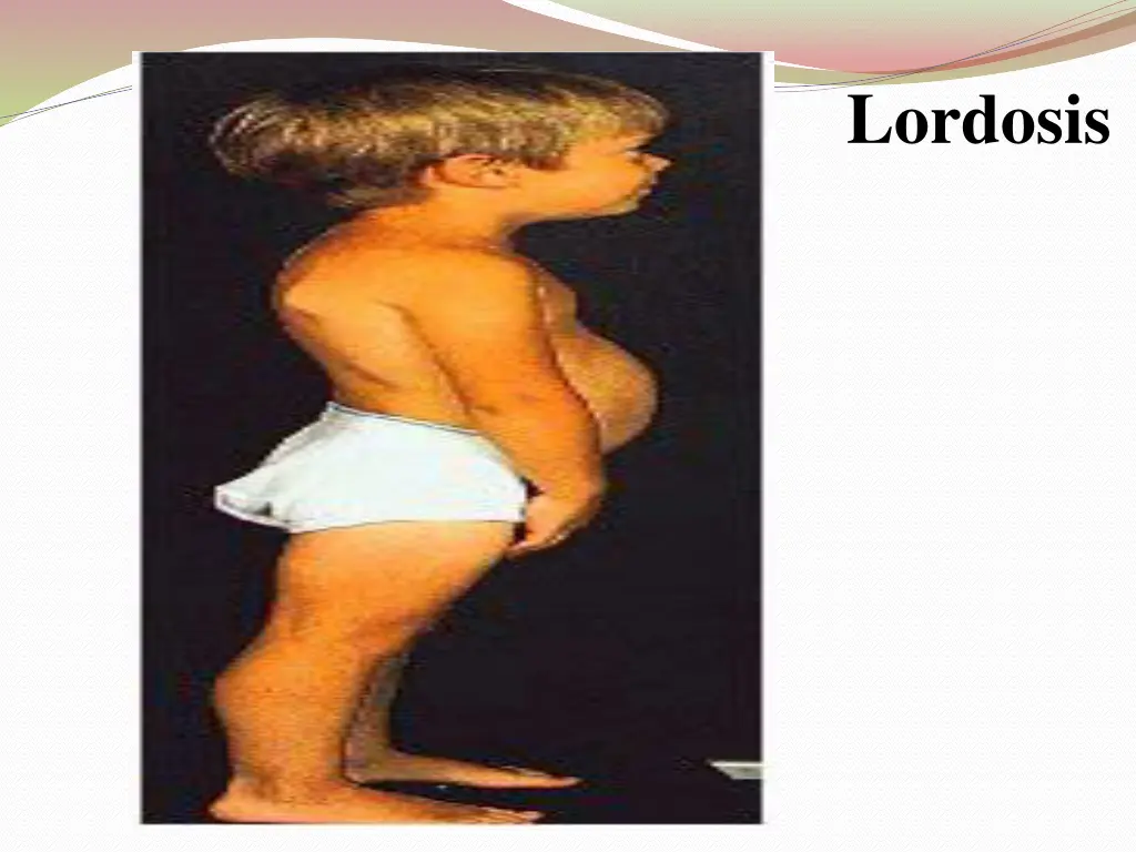 lordosis