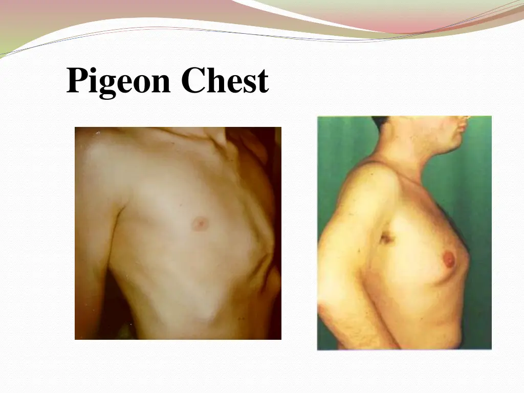 pigeon chest