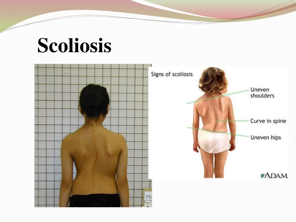 scoliosis