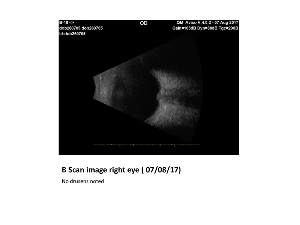 b scan image right eye 07 08 17