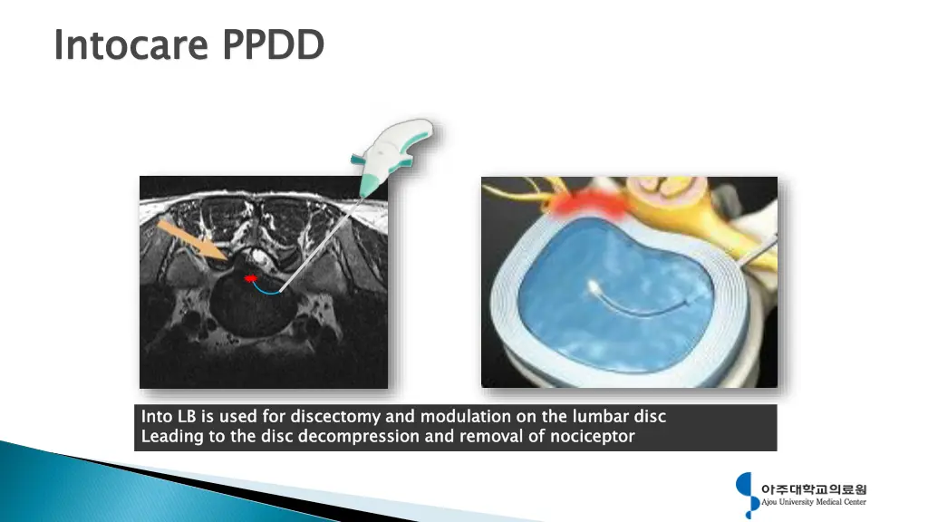 ablation through into series intocare