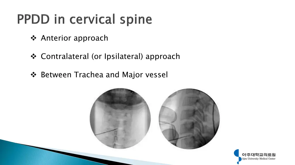 anterior approach