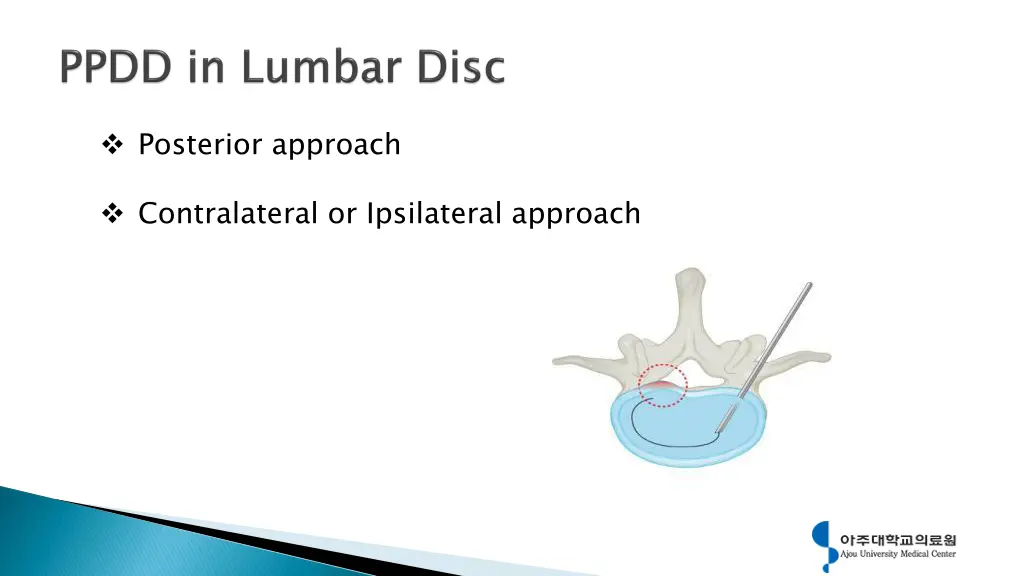 posterior approach