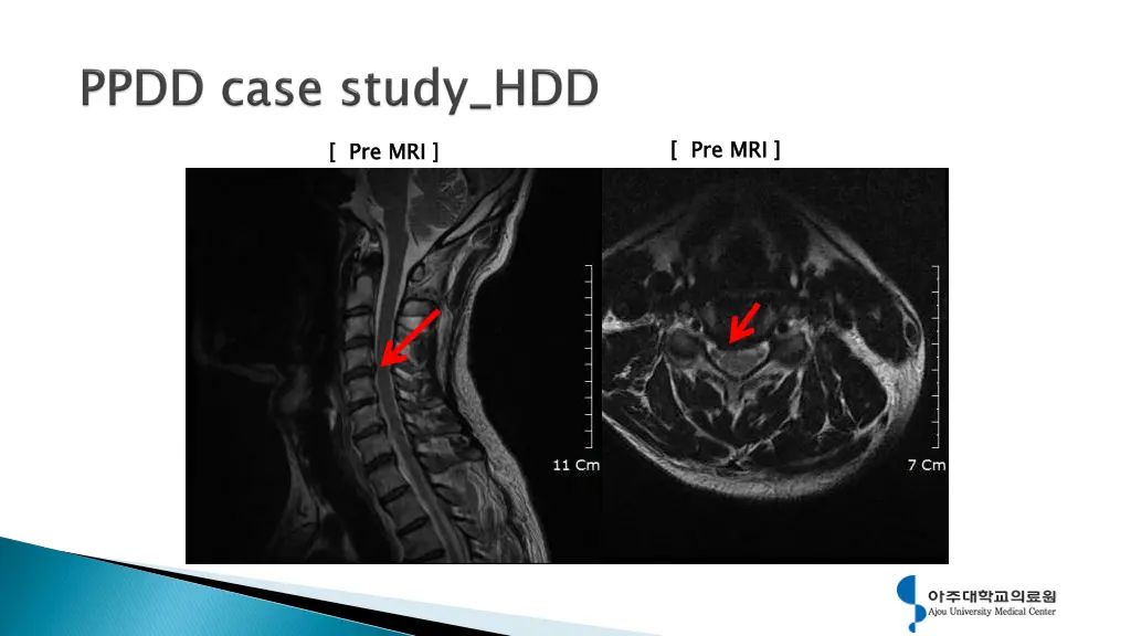 pre mri 1