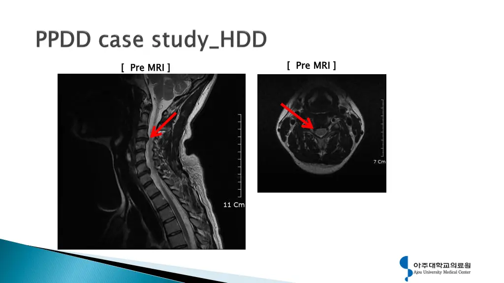 pre mri 2