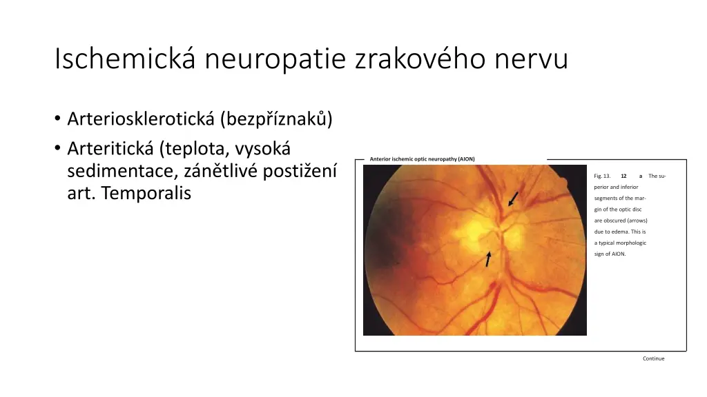 ischemick neuropatie zrakov ho nervu