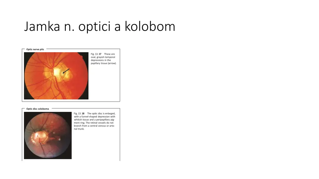 jamka n optici a kolobom