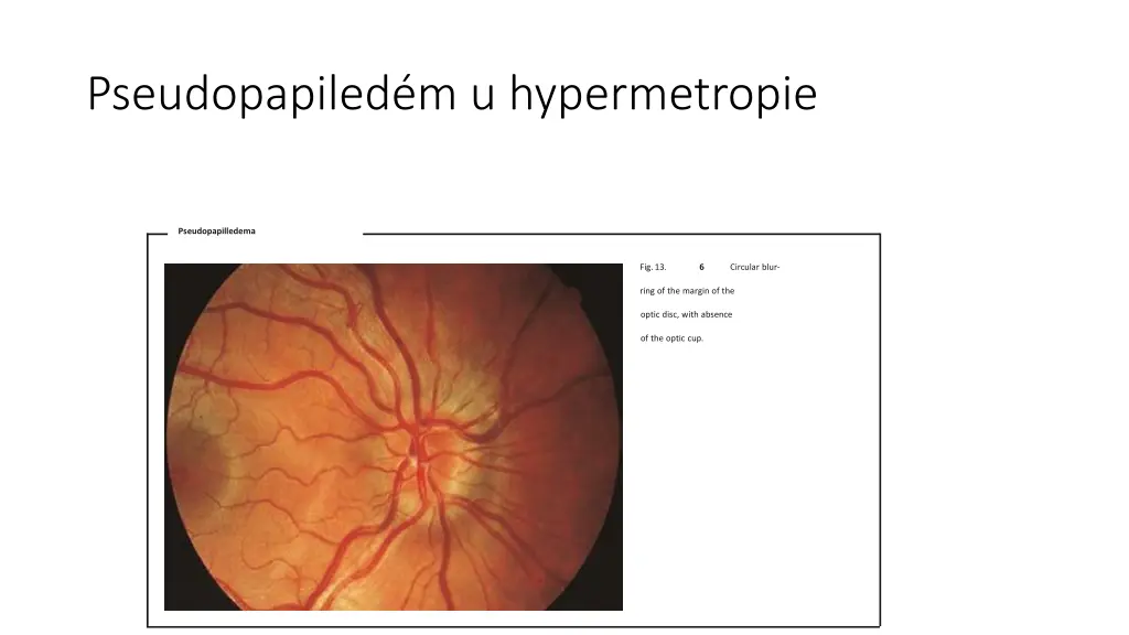 pseudopapiled m u hypermetropie