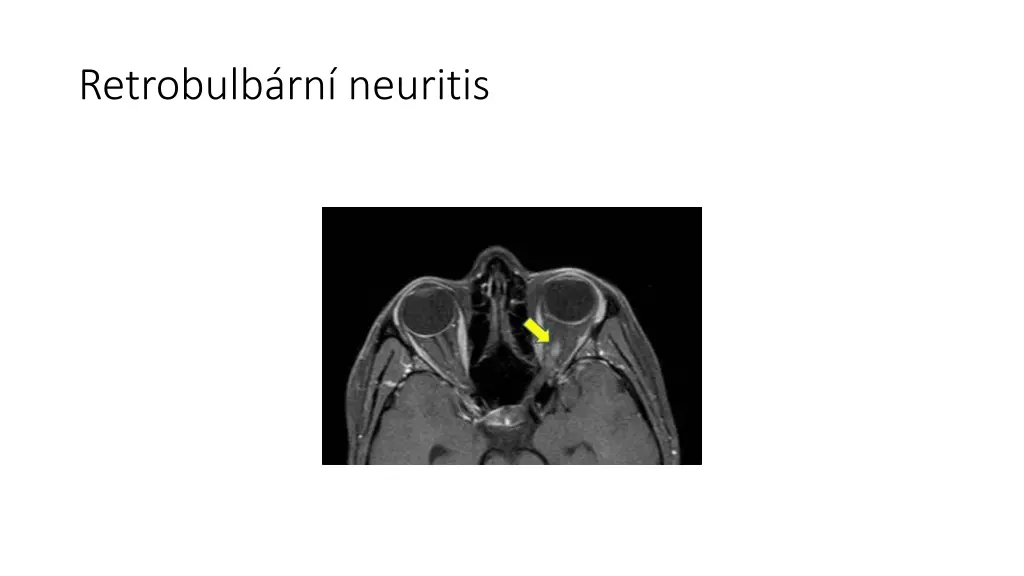 retrobulb rn neuritis